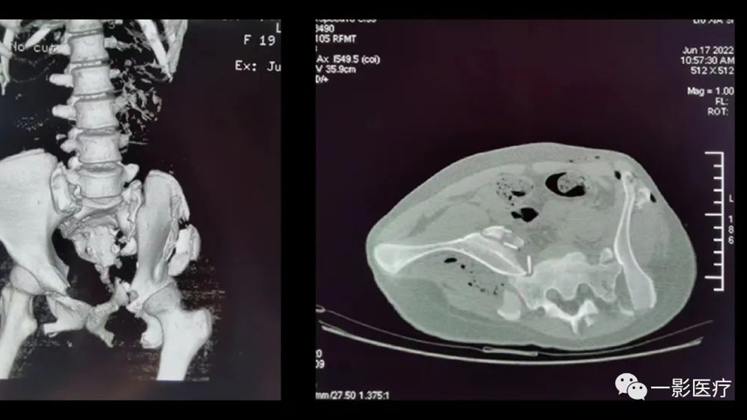 一影临床案例分享（四） | 骶髂关节前脱位病例