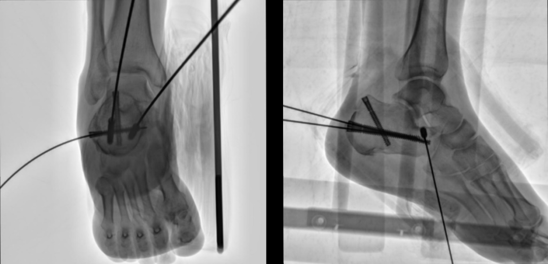 案例分享(十三) | 三维C形臂在跟骨骨折切开复位内固定术中的应用