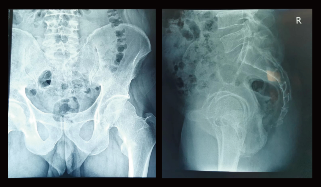 案例分享(十四) | 三维C形臂在骨盆骨折切开复位内固定术中的应用